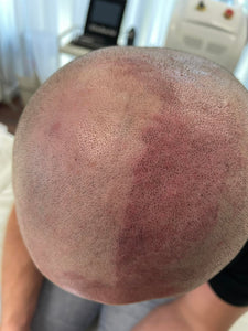 Scalp pigmentation