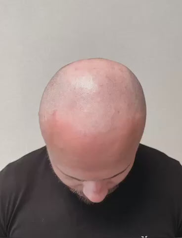 Scalp pigmentation